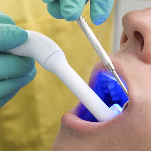 blanqueamiento dental clínica dental ayora